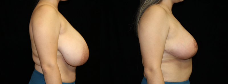 Breast Reduction