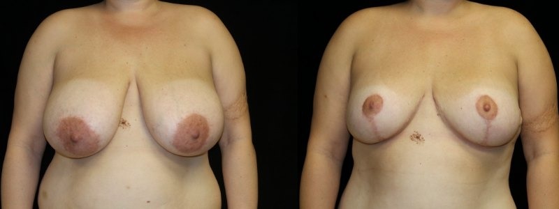 Breast Reduction