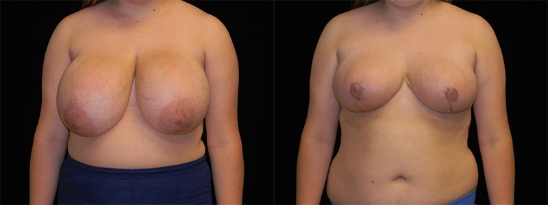 Breast Reduction