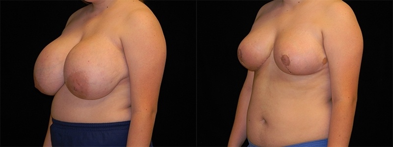 Breast Reduction
