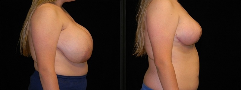 Breast Reduction