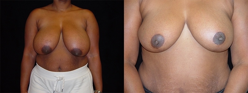 Breast Reduction
