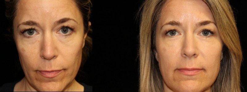 Injectables