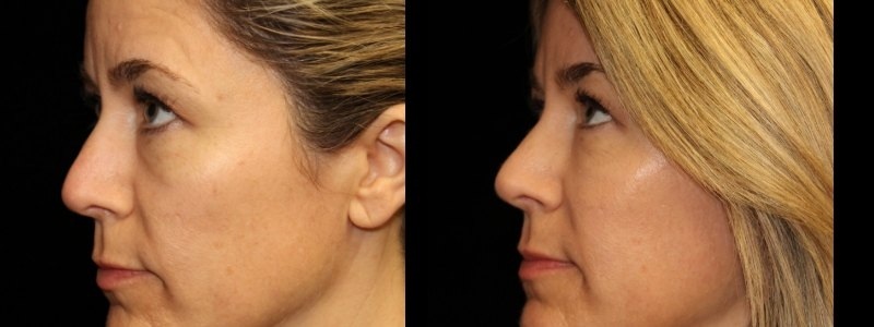 Injectables 2