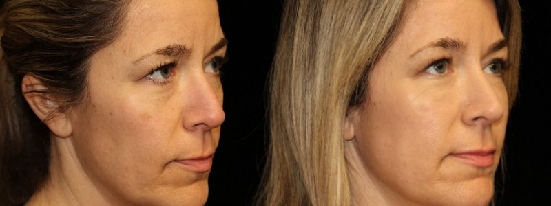 Injectables 3