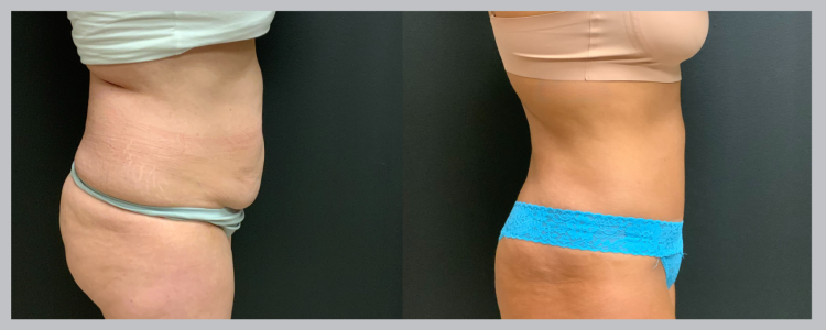 Liposuction