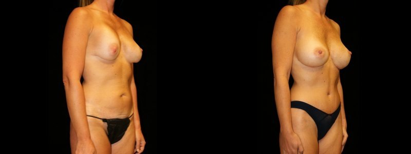 Abdominoplasty with revison of breast augmentation