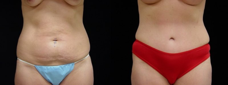 Breast Augmentation, Tummy Tuck, Liposuction