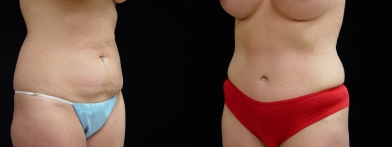 Breast Augmentation, Tummy Tuck, Liposuction