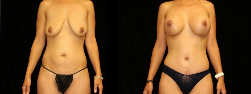 Tummy Tuck with Breast Augmentation and Lift