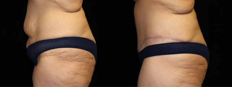 Extended Abdominoplasty