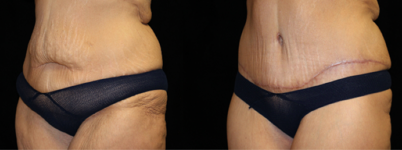 Extended Abdominoplasty