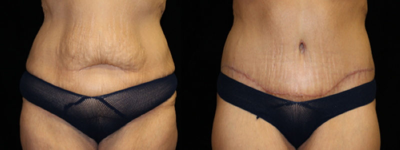 Extended Abdominoplasty