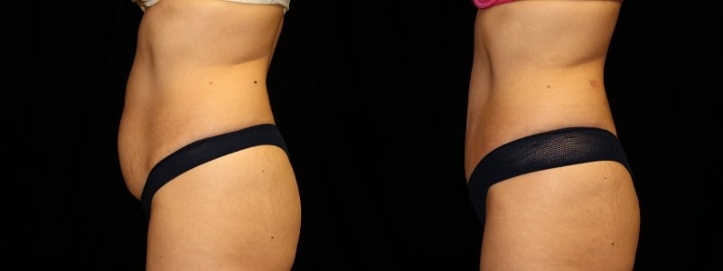 Tummy Tuck