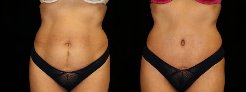 Tummy Tuck