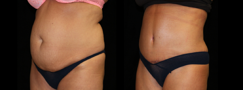 Tummy Tuck