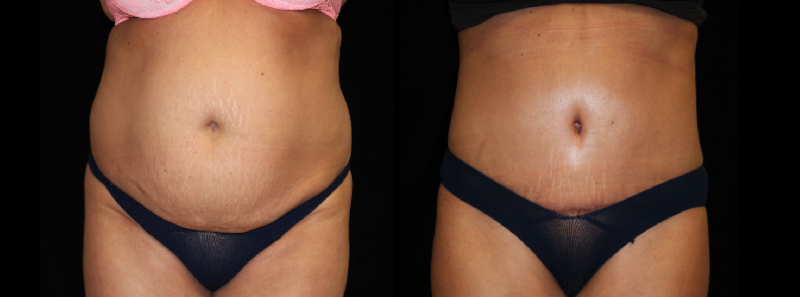 Tummy Tuck