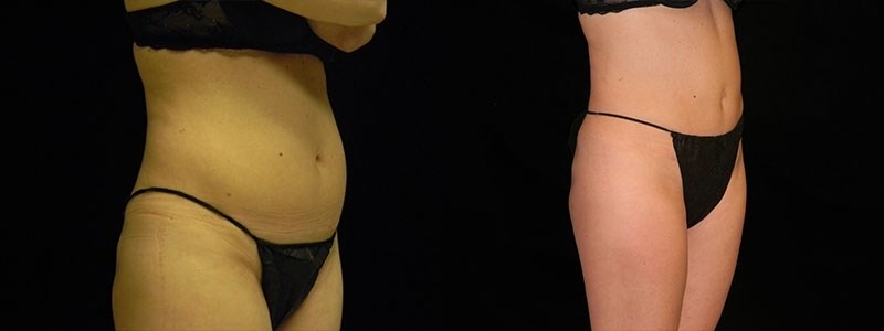 Tummy Tuck