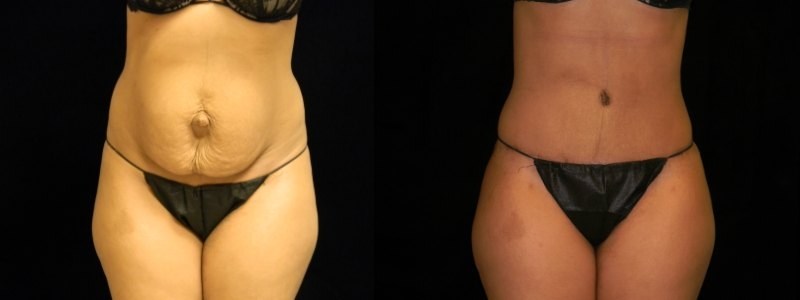 Tummy Tuck