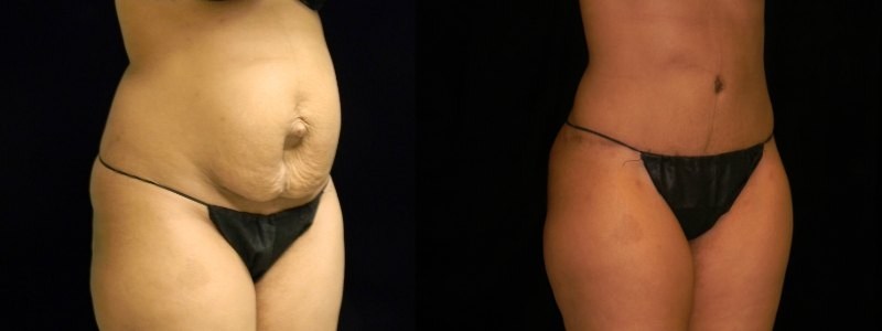 Tummy Tuck