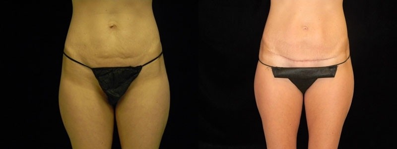 Tummy Tuck