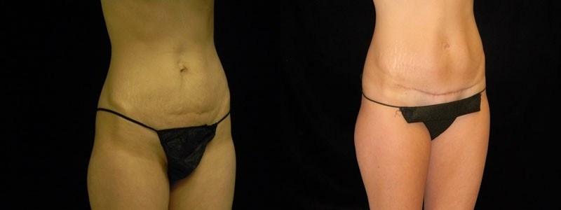 Tummy Tuck
