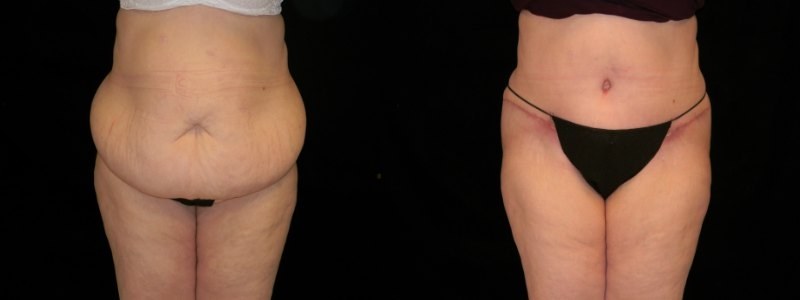 Tummy Tuck