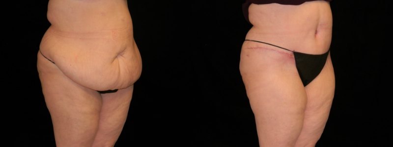 Tummy Tuck