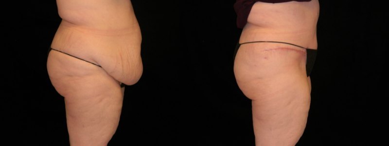 Tummy Tuck