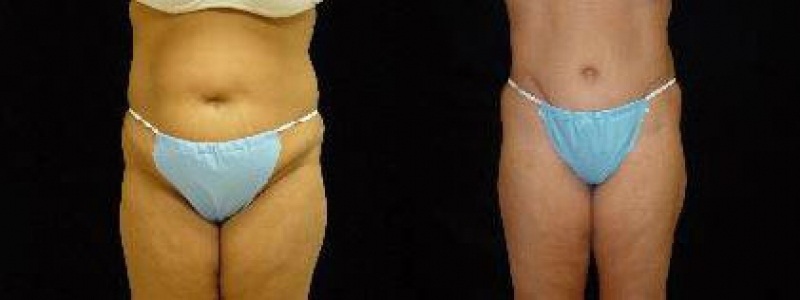 Tummy Tuck