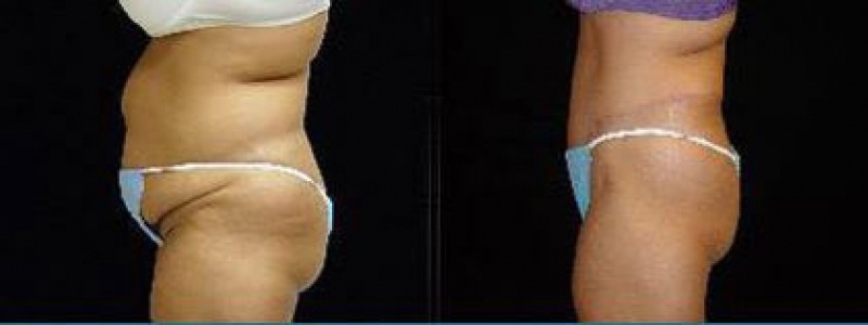 Tummy Tuck