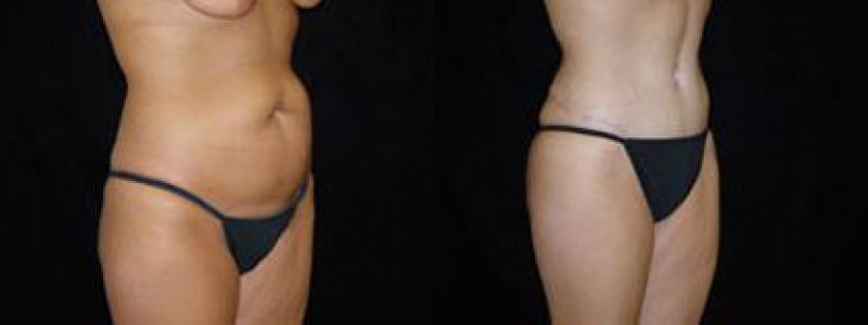 Tummy Tuck