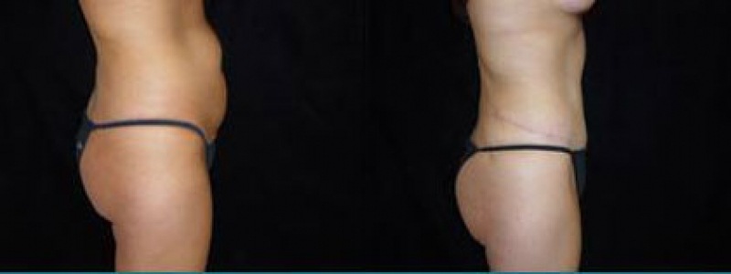 Tummy Tuck