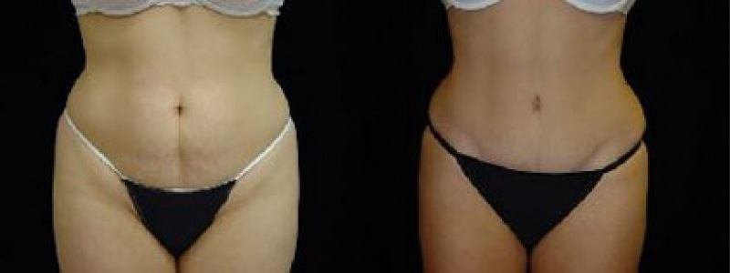 Tummy Tuck