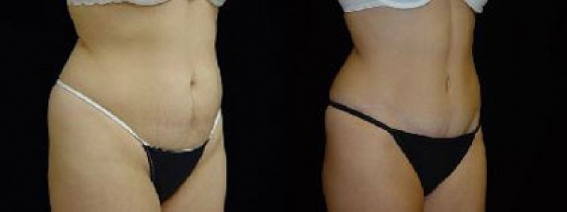 Tummy Tuck