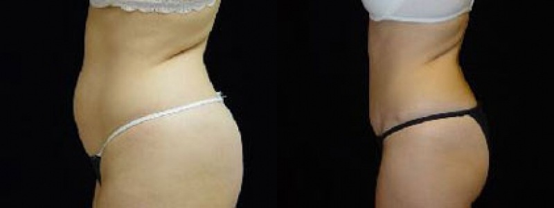 Tummy Tuck