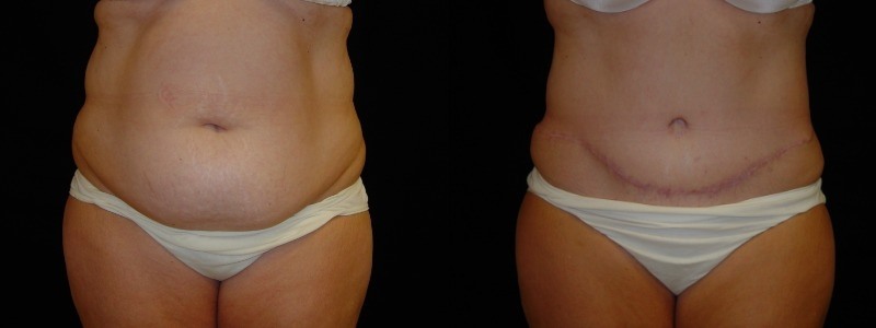 Tummy Tuck