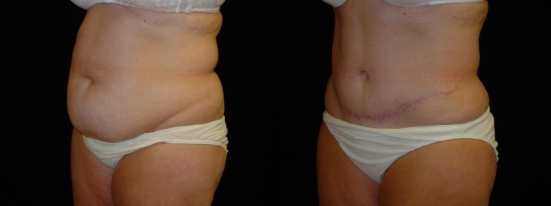 Tummy Tuck