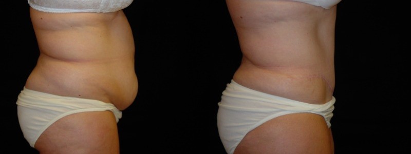 Tummy Tuck