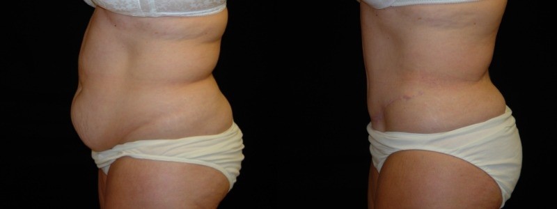 Tummy Tuck