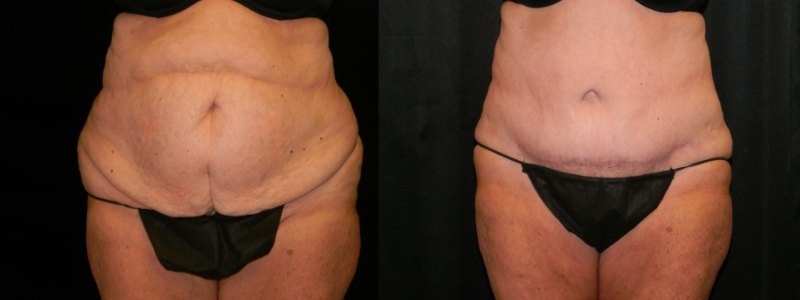 Tummy Tuck