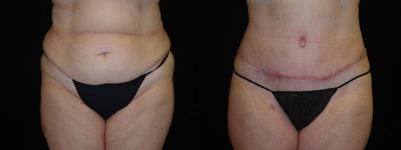 Tummy Tuck