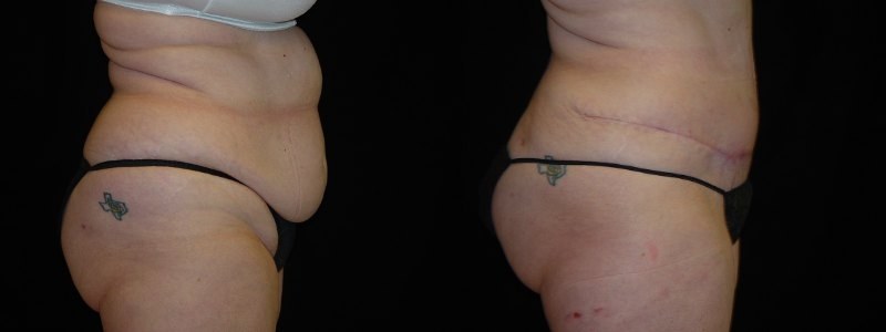 Tummy Tuck