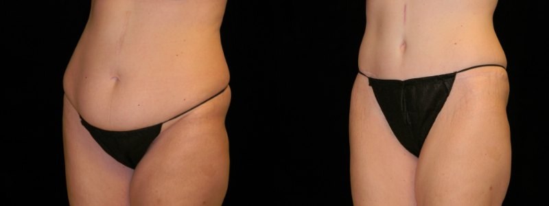 Tummy Tuck