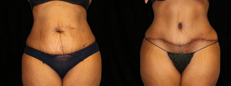 Tummy Tuck
