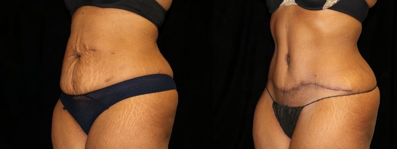 Tummy Tuck
