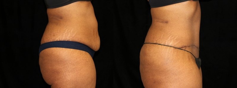 Tummy Tuck