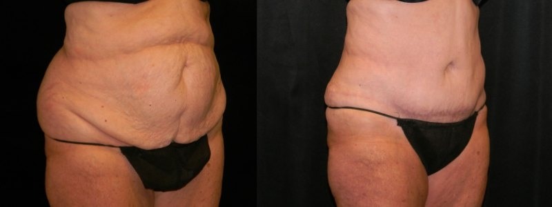 Tummy Tuck