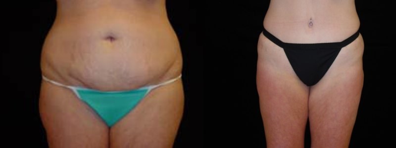 Tummy Tuck