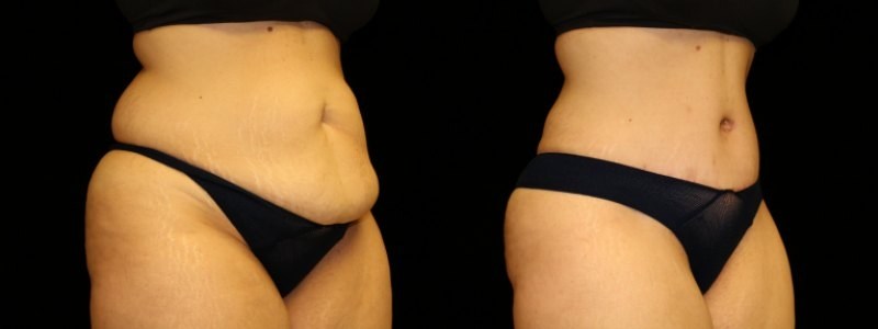 Tummy Tuck and Liposuction